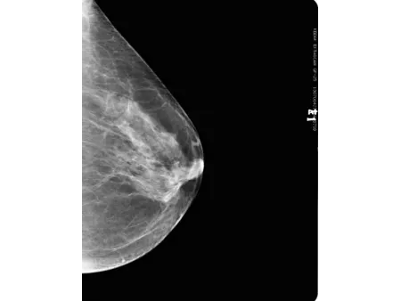 Système de mammographie numérique/Appareil de mamographie
