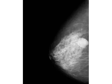 Système de mammographie numérique/Appareil de mamographie