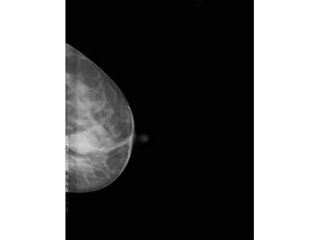 Système de mammographie numérique/Appareil de mamographie