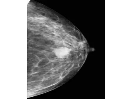 Système de mammographie numérique/Appareil de mamographie